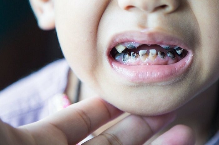 Tình trạng sâu răng có thể ảnh hưởng tiêu cực đến sự phát triển của trẻ
